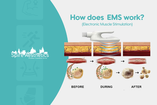 EMS treatment for post pregnancy weight loss treatment Wembley