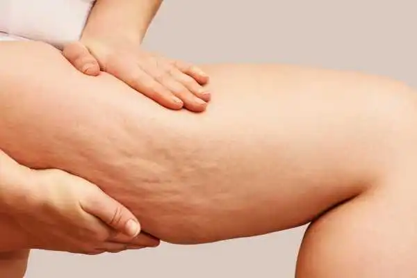 Image of woman showing leg with cellulite Wembley