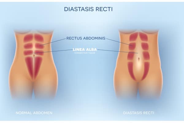 What Non-Surgical Options Are Available for Diastasis Recti Wembley?