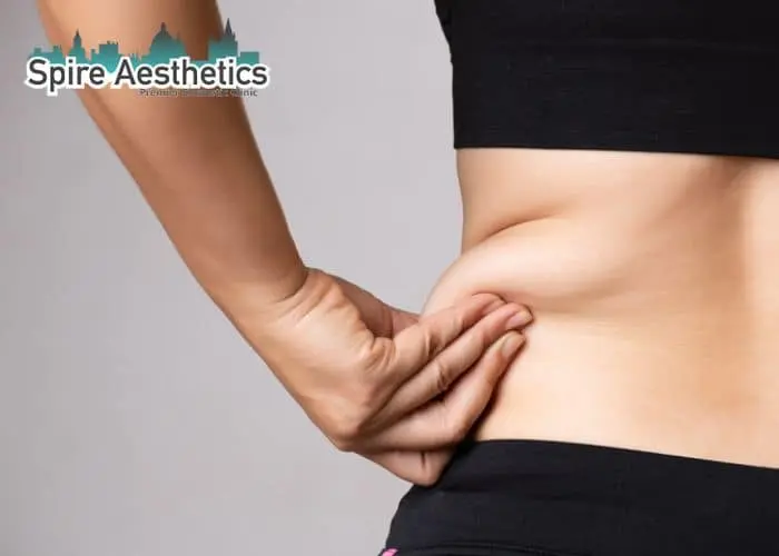 Image of woman pinching fat on their hips Wembley. Fat Freezing treatment
