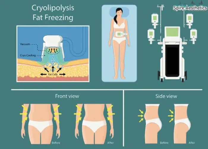 Fat freezing treatment Wembley benefits for competitions to remove stubborn fat deposits.
