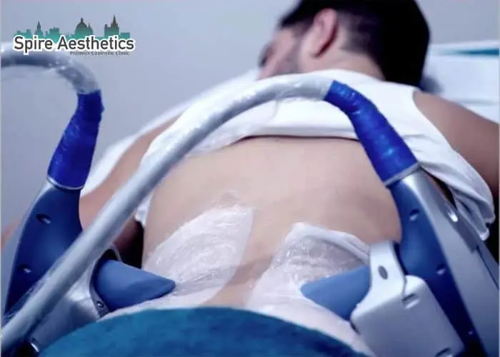 Man having fat freezing treatment done on love handles before a competitions Wembley to create a sculpted look.