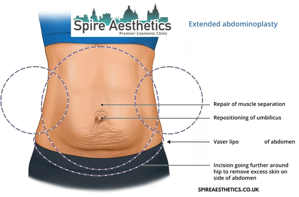 Understanding Loose Skin After Gastric Band Wembley Surgery and HIFU Treatment