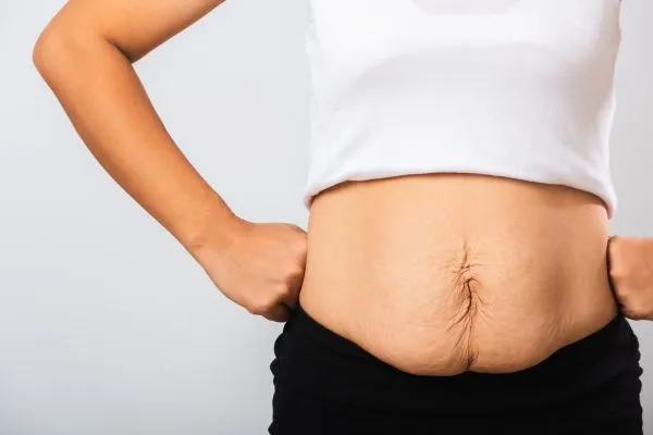Image of a woman's stomach after weight loss with sagging skin following a gastric band Wembley