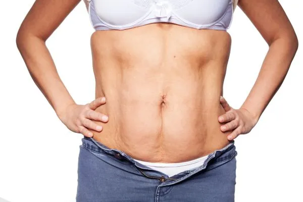 sagging skin on woman's stomach after weight loss injections Wembley