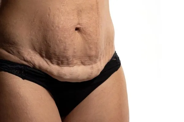 Image of womans stomach after weight loss injections Wembley showing saggy skin
