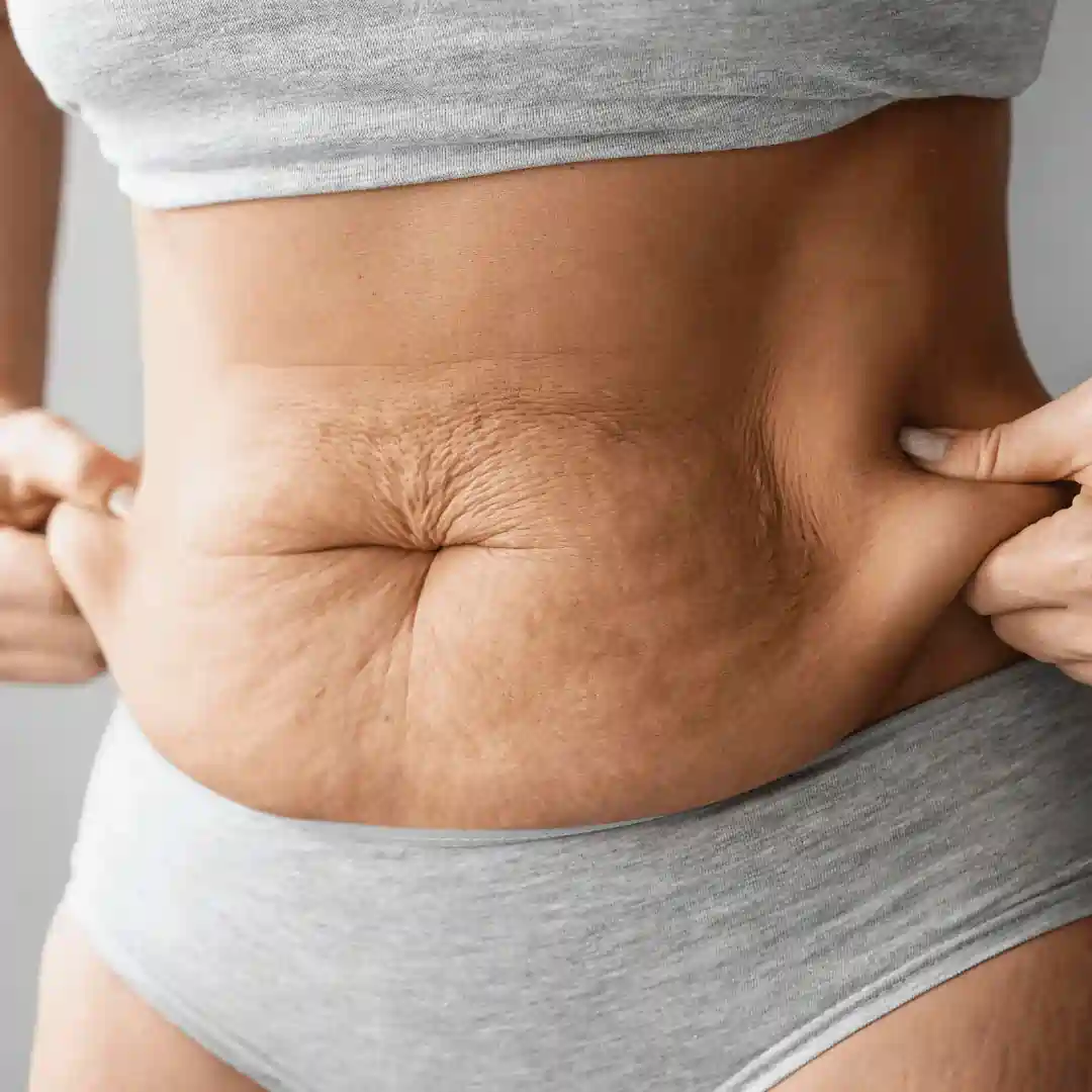 Is It Normal to Have Loose Skin After Pregnancy Wembley?
