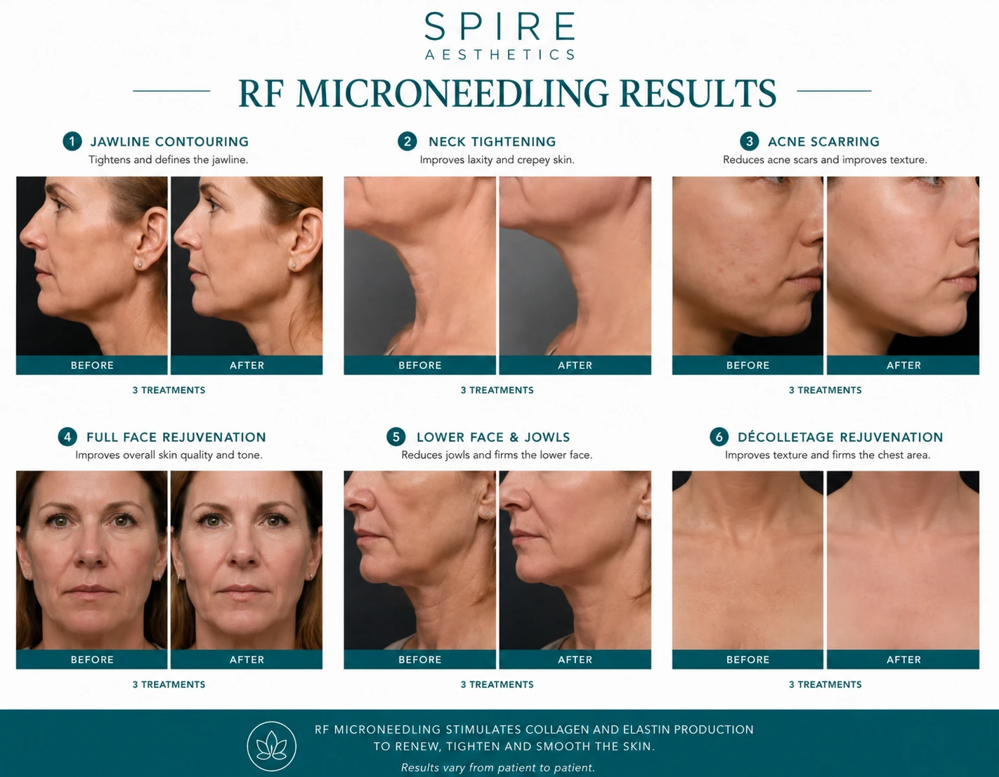 RF Microneedling Skin tightening Wembley results