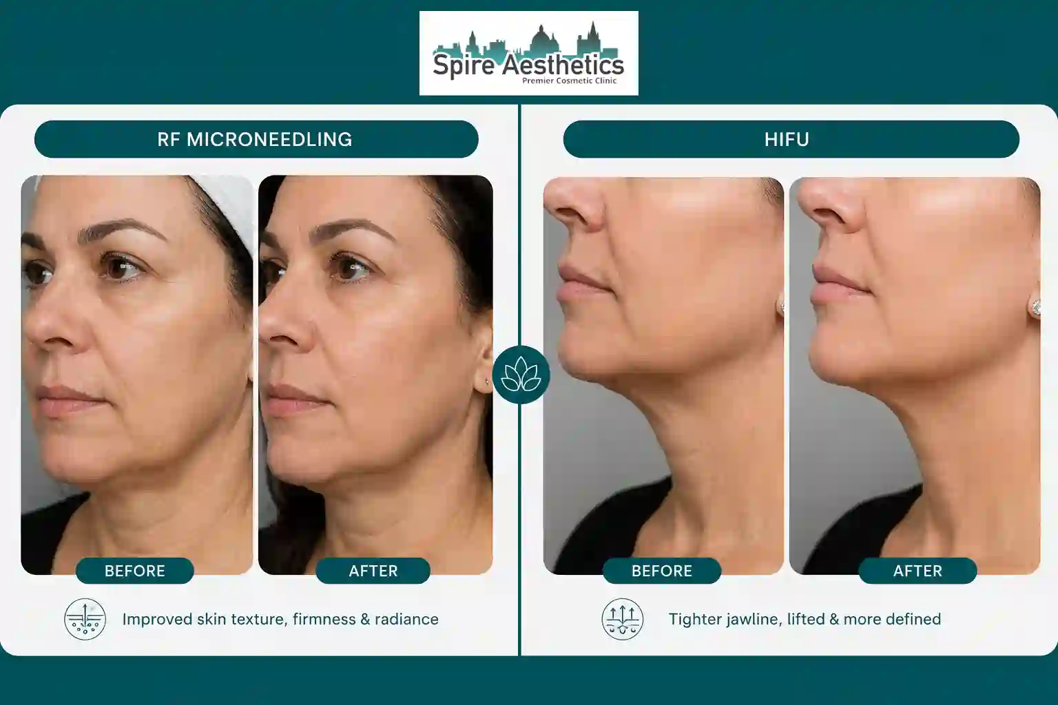 Can RF Microneedling and HIFU Be Combined Wembley?