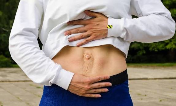 When Could Diastasis Recti Be the Missing Piece of the Puzzle Wembley?