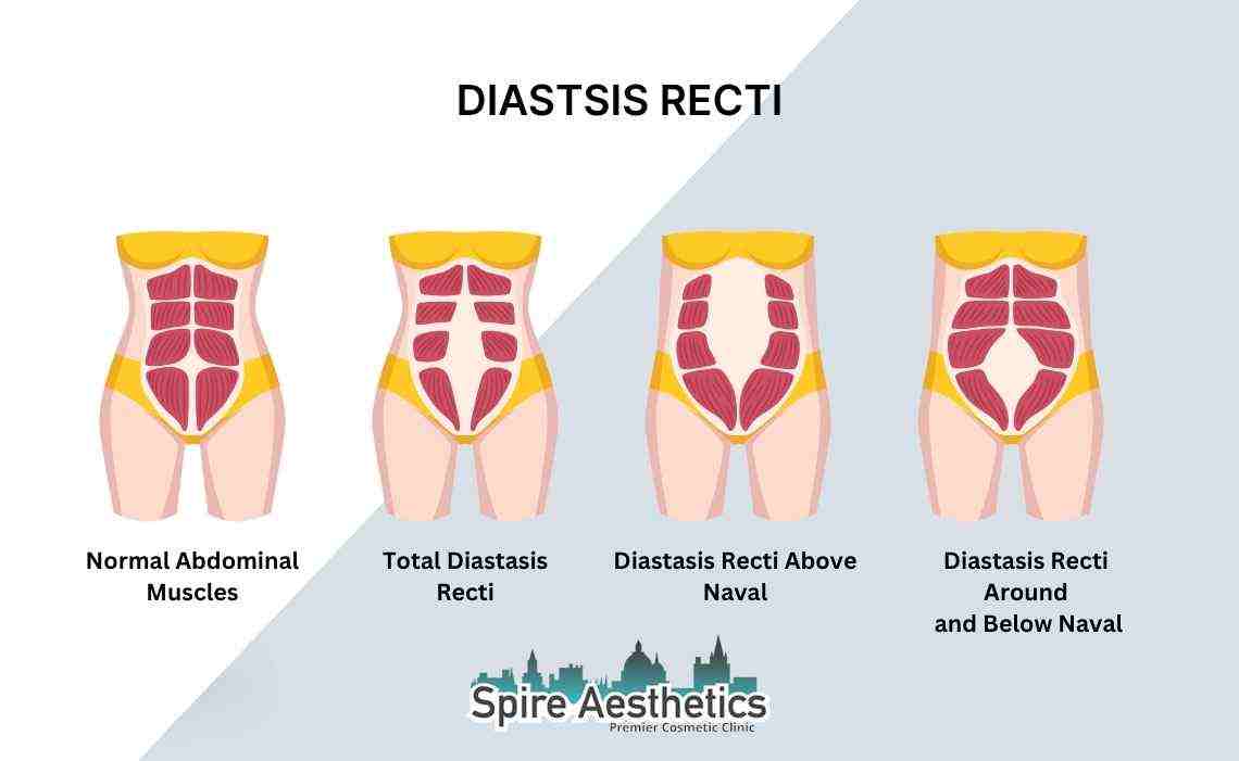 Is Non-Surgical Diastasis Recti Treatment Right for You? Common Concerns Answered Wembley
